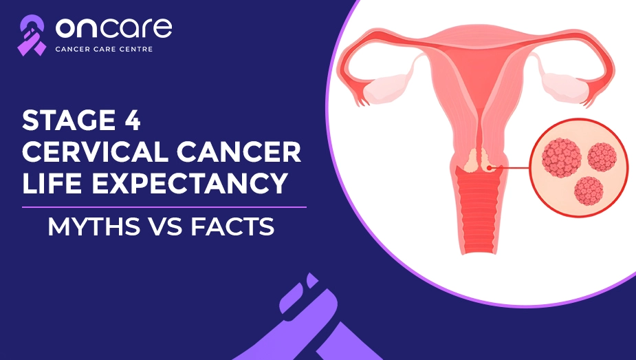 What are the myths and facts about Stage 4 cervical cancer?